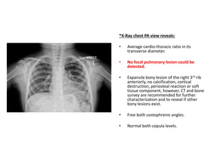 *X-Ray chest PA view reveals:
• Average cardio-thoracic ratio in its
transverse diameter.
• No focal pulmonary lesion could be
detected.
• Expansile bony lesion of the right 3rd rib
anteriorly, no calcification, cortical
destruction, periosteal reaction or soft
tissue component, however, CT and bone
survey are recommended for further
characterization and to reveal if other
bony lesions exist.
• Free both costophrenic angles.
• Normal both copula levels.
 