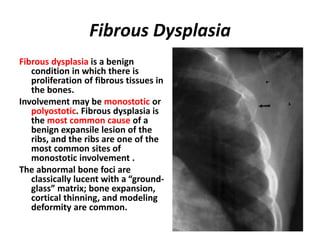 Fibrous Dysplasia
Fibrous dysplasia is a benign
condition in which there is
proliferation of fibrous tissues in
the bones.
Involvement may be monostotic or
polyostotic. Fibrous dysplasia is
the most common cause of a
benign expansile lesion of the
ribs, and the ribs are one of the
most common sites of
monostotic involvement .
The abnormal bone foci are
classically lucent with a “ground-
glass” matrix; bone expansion,
cortical thinning, and modeling
deformity are common.
 