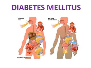 DIABETES MELLITUS

 