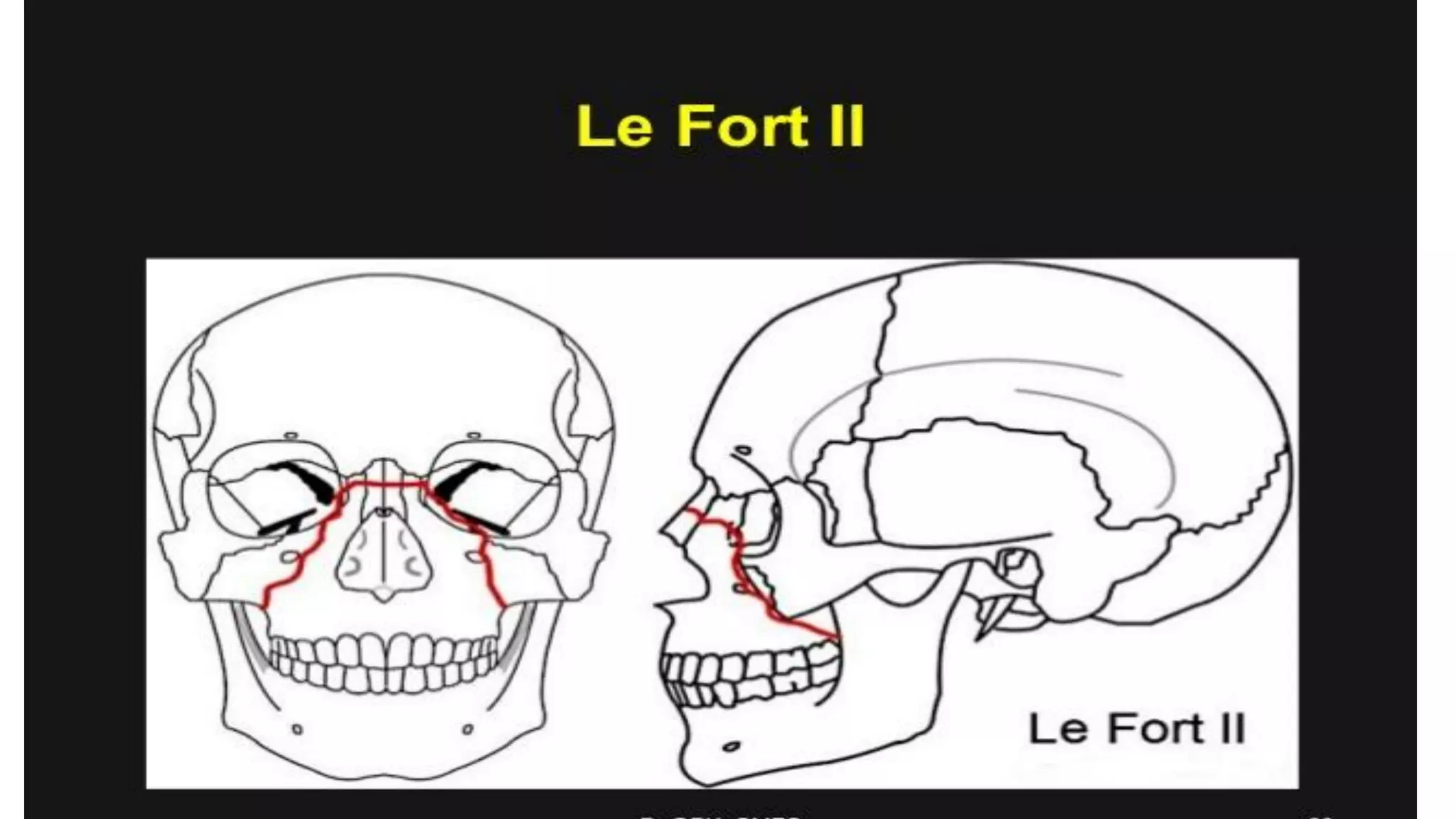 Le Fort Fractures | PDF