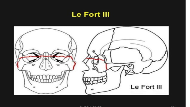 Le Fort Fractures | PDF