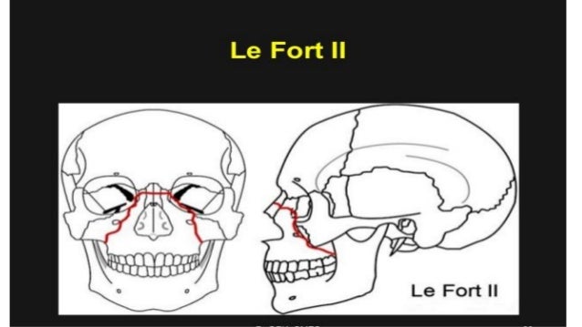Le Fort Fractures