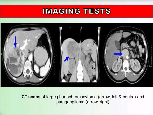 app blood test pressure PHEOCHROMOCYTOMA app blood test pressure PHEOCHROMOCYTOMA