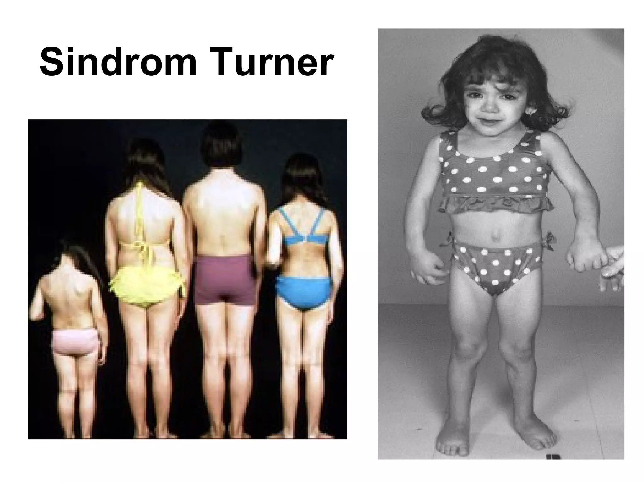 Sindrom Turner




                 46
 