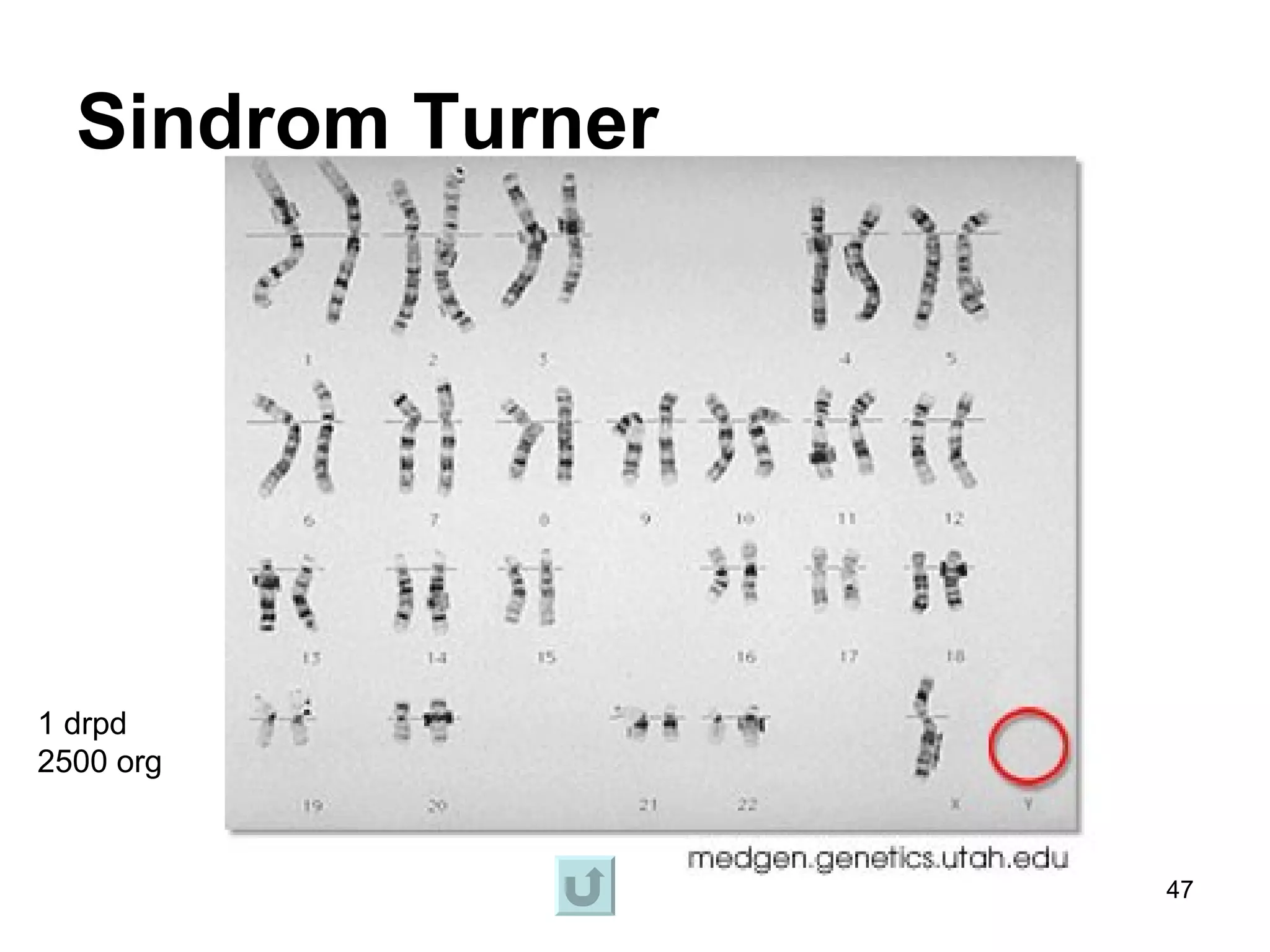 Sindrom Turner




1 drpd
2500 org


                   47
 