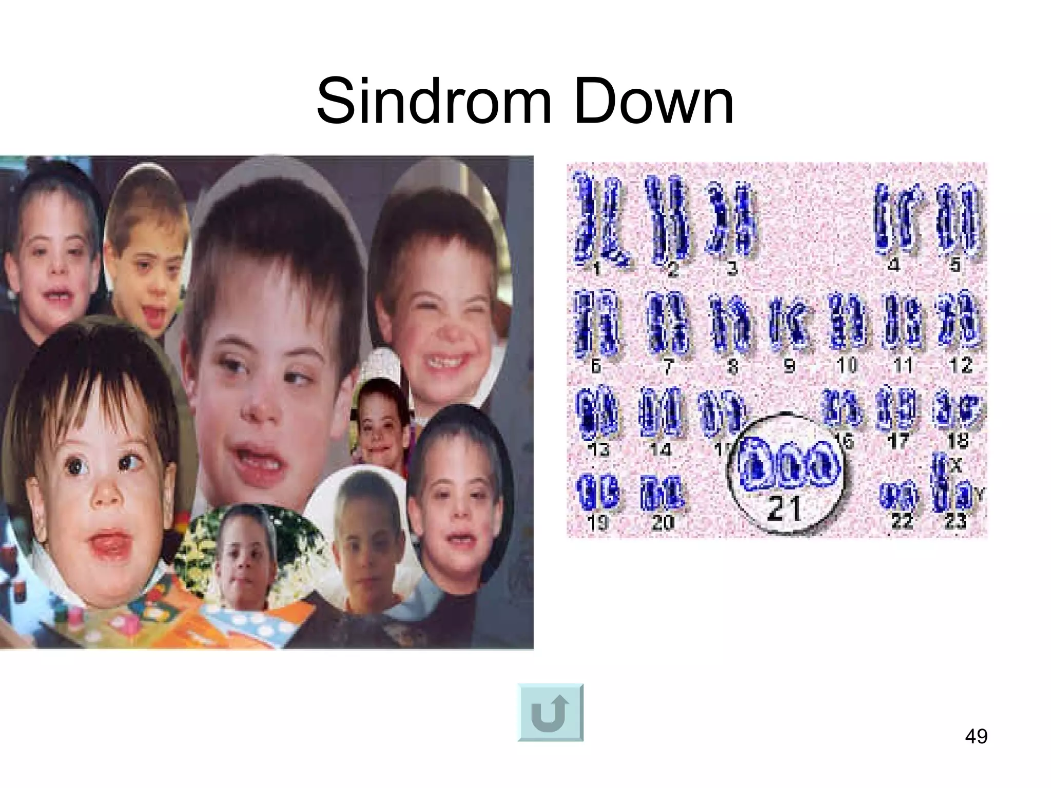 Sindrom Down




               49
 