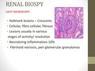 RENAL BIOSPY
LIGHT MICROSCOPY:
• Hallmark lesions – Crescents
• Cellular, fibro cellular, fibrous
• Lesions usually in various
stages of activity/ resolution
• Necrotizing inflammation-10%
• Fibrinoid necrosis, peri glomerular granulomas
 