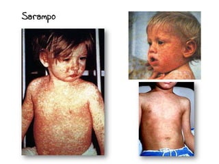 Sarampo
 