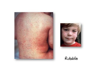 Rubéola
 