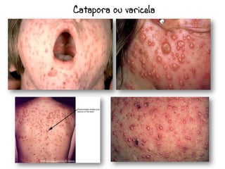 Catapora ou varicela
 