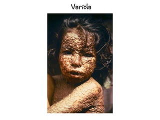 Varíola
 