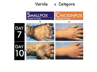 Varíola   x Catapora
 