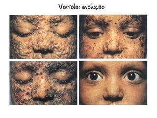 Varíola: evolução
 