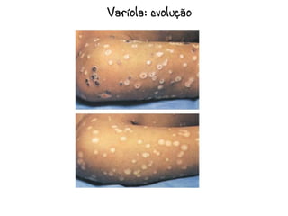 Varíola: evolução
 