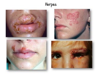 Herpes
 