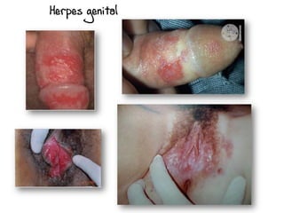 Herpes genital
 