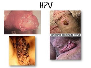 HPV
 