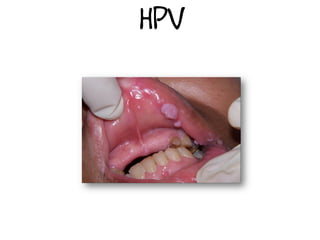 HPV
 