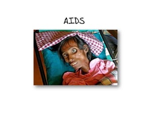 AIDS
 