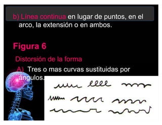 b) Línea continua en lugar de puntos, en el
arco, la extensión o en ambos.
Figura 6Figura 6
Distorsión de la forma
A) Tres o mas curvas sustituidas por
ángulos.
 
