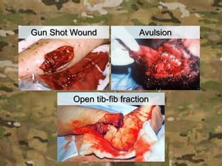 Gun Shot Wound Avulsion
Open tib-fib fraction
 