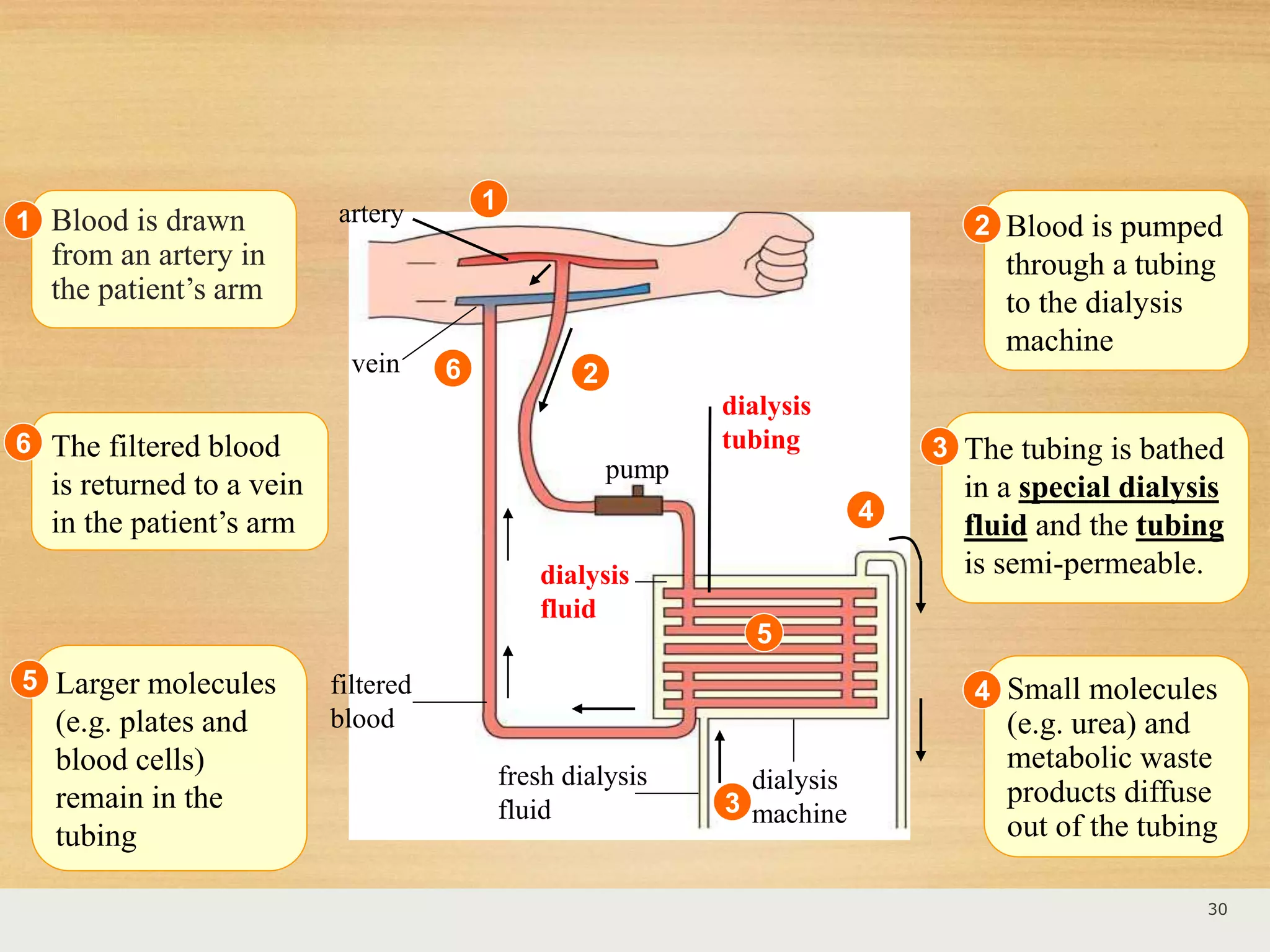 Larger molecules
(e.g. plates and
blood cells)
remain in the
tubing
The filtered blood
is returned to a vein
in the patient’s arm
artery
dialysis
tubing
pump
filtered
blood
fresh dialysis
fluid
dialysis
machine
dialysis
fluid
vein
1
2
3
6
4
5
30
Blood is drawn
from an artery in
the patient’s arm
1 Blood is pumped
through a tubing
to the dialysis
machine
2
The tubing is bathed
in a special dialysis
fluid and the tubing
is semi-permeable.
3
Small molecules
(e.g. urea) and
metabolic waste
products diffuse
out of the tubing
45
6
 