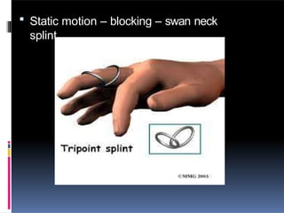  Static motion – blocking – swan neck
splint
 