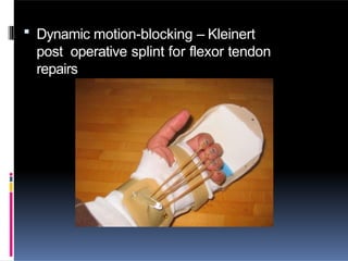  Dynamic motion-blocking – Kleinert
post operative splint for flexor tendon
repairs
 