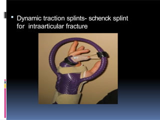  Dynamic traction splints- schenck splint
for intraarticular fracture
 
