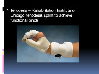  Tenodesis – Rehabilitation Institute of
Chicago tenodesis splint to achieve
functional pinch
 