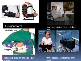 Functional arm
orthosis
Arm suspension sling – deltoid
aid
Balanced forearm orthosis- gun Arm supports- wheelchair arm
 
