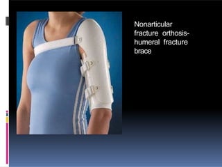 Nonarticular
fracture orthosis-
humeral fracture
brace
 