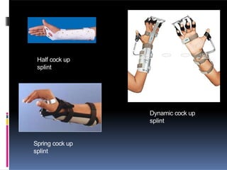 Dynamic cock up
splint
Half cock up
splint
Spring cock up
splint
 