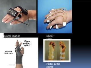 Bunnell knuckle
bender
Spider
splint
Radial gutter
splints
 