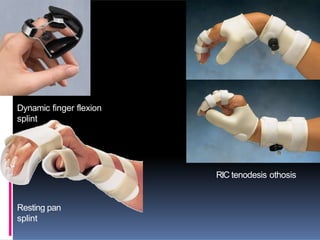 Dynamic finger flexion
splint
RIC tenodesis othosis
Resting pan
splint
 