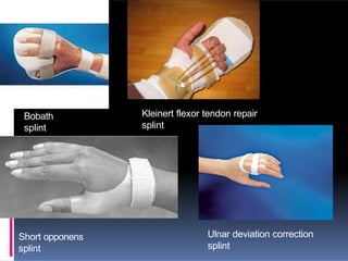 Bobath
splint
Kleinert flexor tendon repair
splint
Short opponens
splint
Ulnar deviation correction
splint
 
