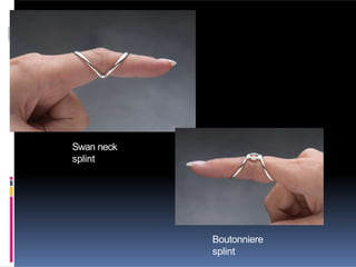 Swan neck
splint
Boutonniere
splint
 