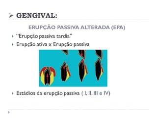 ➢ GENGIVAL:
ERUPÇÃO PASSIVA ALTERADA (EPA)
 “Erupção passiva tardia”
 Erupção ativa x Erupção passiva
 Estádios da erupção passiva ( I, II, III e IV)
 