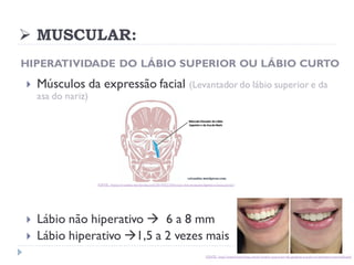 ➢ MUSCULAR:
HIPERATIVIDADE DO LÁBIO SUPERIOR OU LÁBIO CURTO
 Músculos da expressão facial (Levantador do lábio superior e da
asa do nariz)
 Lábio não hiperativo → 6 a 8 mm
 Lábio hiperativo →1,5 a 2 vezes mais
FONTE: https://ericasitta.wordpress.com/2014/02/24/funcao-dos-musculos-ligados-a-boca-parte-i/
FONTE: http://institutobarbosa.com.br/post/o-que-e-sorriso-gengival-e-qual-o-tratamento-mais-indicado/
 