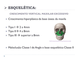 ➢ ESQUELÉTICA:
CRESCIMENTO VERTICAL MAXILAR EXCESSIVO
 Crescimento hiperplásico da base óssea da maxila
 Tipo I → 2 a 4mm
 Tipo II→ 4 a 8mm
 Tipo III → superior a 8mm
 Maloclusão Classe I de Angle e base esquelética Classe II
FONTE:https://www.odontoup.com.br/anatomia-da-maxila/
 