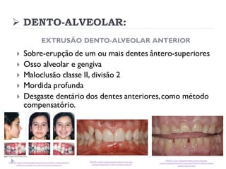 ➢ DENTO-ALVEOLAR:
EXTRUSÃO DENTO-ALVEOLAR ANTERIOR
 Sobre-erupção de um ou mais dentes ântero-superiores
 Osso alveolar e gengiva
 Maloclusão classe II, divisão 2
 Mordida profunda
 Desgaste dentário dos dentes anteriores,como método
compensatório.
FONTE: https://www.dentalpress.com.br/portal/ma-oclusao-classe-ii-
divisao-2-de-angle-com-sobremordida-acentuada-3/
FONTE: https://www.drpaulocoelho.com.br/wp-
content/uploads/2017/05/mordida-profunda
FONTE: http://luisgustavoleite.com.br/blog/wp-
content/uploads/2016/01/restura%C3%A7%C3%A3o-dentes-
anteriores-bruxismo
 