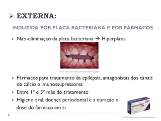 ➢ EXTERNA:
INDUZIDA POR PLACA BACTERIANA E POR FÁRMACOS
 Não-eliminação da placa bacteriana → Hiperplasia
 Fármacos para tratamento da epilepsia, antagonistas dos canais
de cálcio e imunossupressores
 Entre 1º e 3º mês do tratamento
 Higiene oral, doença periodontal e a duração e
dose do fármaco em si
FONTE: http://www.revistacirurgiabmf.com/2009/v9n1/08.pdf
FONTE: https://plugadus.com/vida/saude/fenitoina/
 