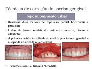 Técnicas de correção do sorriso gengival
Reposicionamento Labial
 Realiza-se duas incisões de espessura parcial, horizontais e
paralelas;
 Linhas de ângulo mesiais dos primeiros molares, direito e
esquerdo;
 A primeira incisão é realizada ao nível da junção mucogengival e
a segunda ao nível da mucosa labial.
 Fonte: (Rosenblatt et al., 2006, apud, PINTO,2016).
 