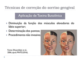 Técnicas de correção do sorriso gengival
Aplicação deToxina Butolínica
 Diminuição da função dos músculos elevadores do
lábio superior;
 Determinação dos pontos;
 Procedimento não invasivo;
Fonte: (Rosenblatt et al.,
2006, apud, PINTO,2016).
 