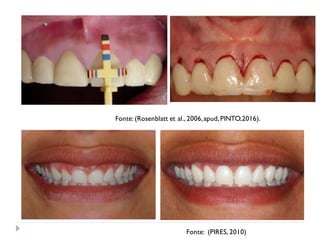 Fonte: (Rosenblatt et al., 2006,apud, PINTO,2016).
Fonte: (PIRES, 2010)
 
