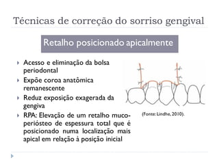 Técnicas de correção do sorriso gengival
Retalho posicionado apicalmente
 Acesso e eliminação da bolsa
periodontal
 Expõe coroa anatômica
remanescente
 Reduz exposição exagerada da
gengiva
 RPA: Elevação de um retalho muco-
periósteo de espessura total que é
posicionado numa localização mais
apical em relação à posição inicial
(Fonte: Lindhe, 2010).
 