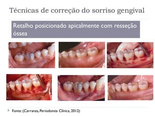 Técnicas de correção do sorriso gengival
Retalho posicionado apicalmente com resseção
óssea

Fonte: (Carranza, Periodontia Clínica, 2012)
 