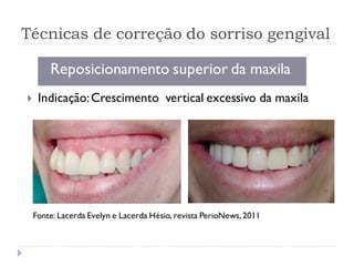 Técnicas de correção do sorriso gengival
Reposicionamento superior da maxila
 Indicação:Crescimento vertical excessivo da maxila
Fonte: Lacerda Evelyn e Lacerda Hésio, revista PerioNews, 2011
 