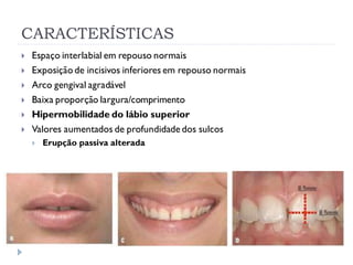 CARACTERÍSTICAS
 Espaço interlabial em repouso normais
 Exposição de incisivos inferiores em repouso normais
 Arco gengival agradável
 Baixa proporção largura/comprimento
 Hipermobilidade do lábio superior
 Valores aumentados de profundidadedos sulcos
 Erupção passiva alterada
 