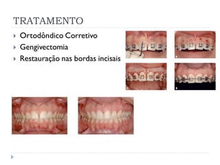 TRATAMENTO
 Ortodôndico Corretivo
 Gengivectomia
 Restauração nas bordas incisais
 